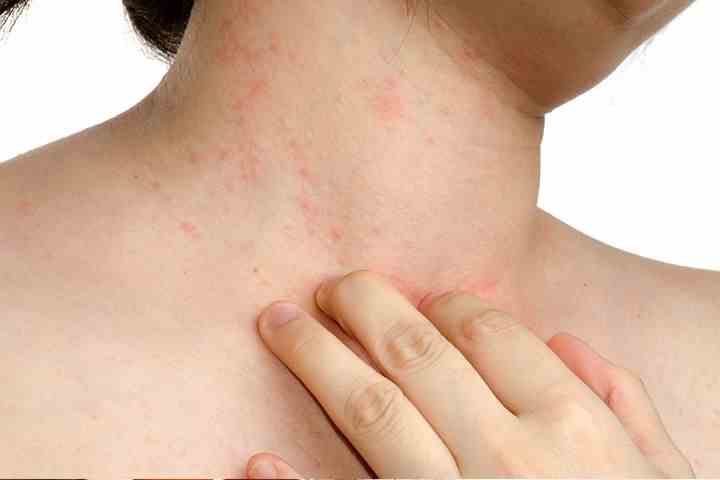 TOP 10 Home Remédios Para Tratar Alergias Da Pele