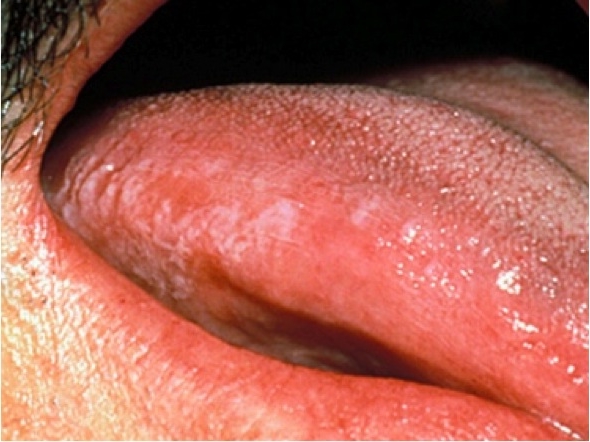 cuales-son-los-primeros-sintomas-del-cancer-de-lengua_1496
