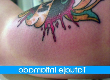 sintomas-de-un-tatuaje-infectado_1443