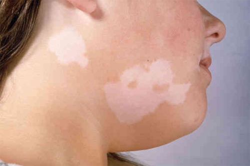 vitiligo_1388