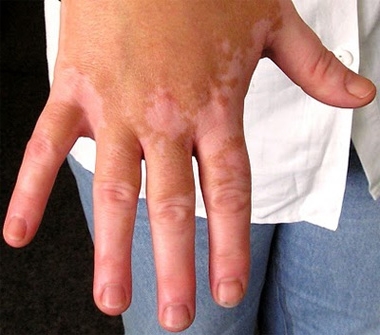 vitiligo_1402