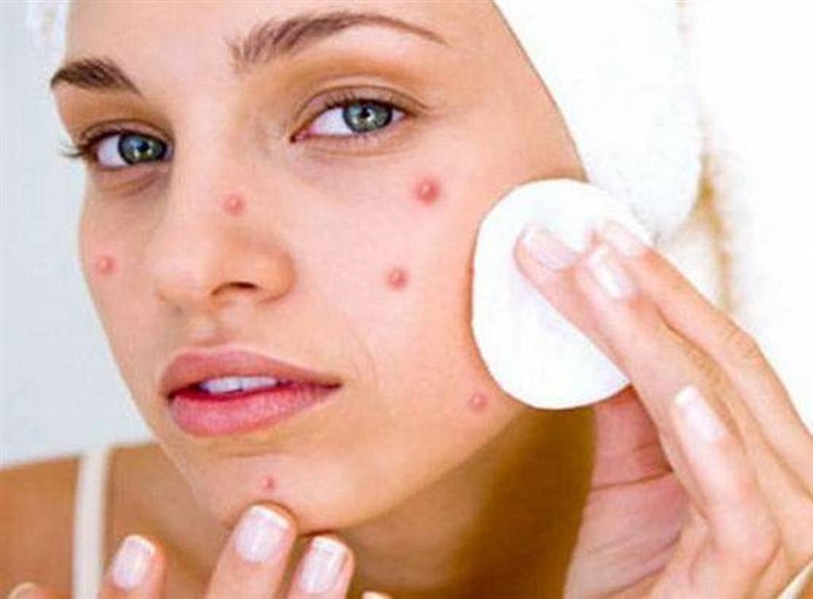distingue-diferentes-tipos-de-acne-afetar-o-rosto-2