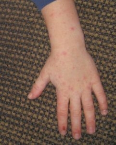 o-virus-coxsackie-afeta-menos-de-cinco-anos-8